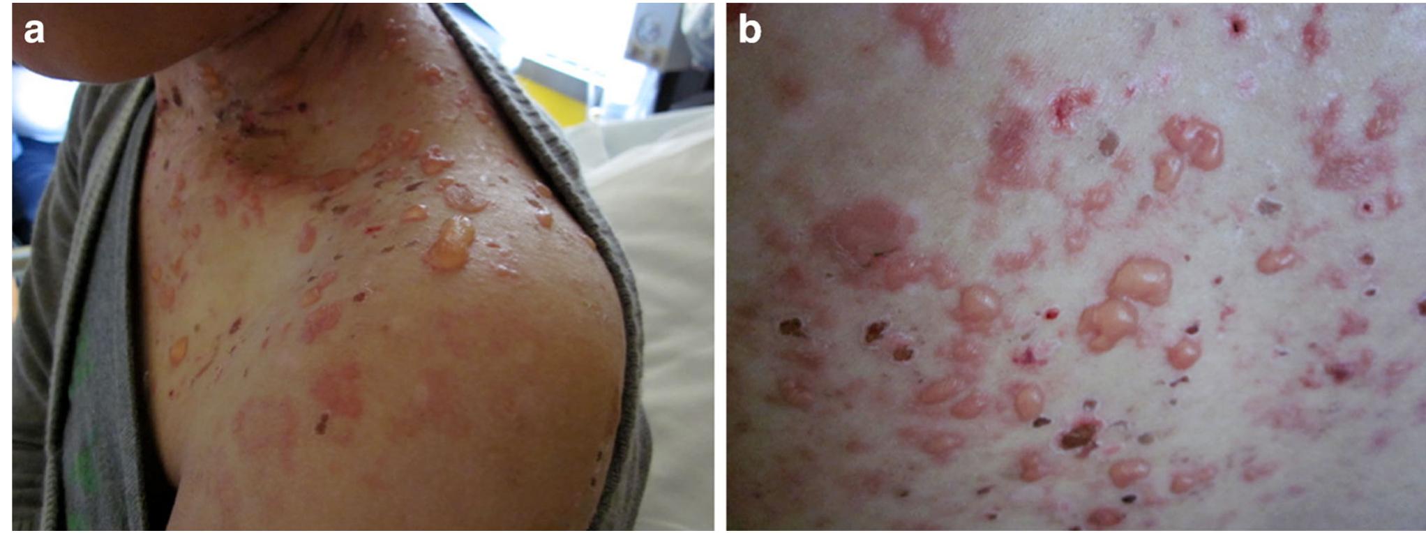 (PDF) Bullous systemic lupus erythematosus: a review and update to ...