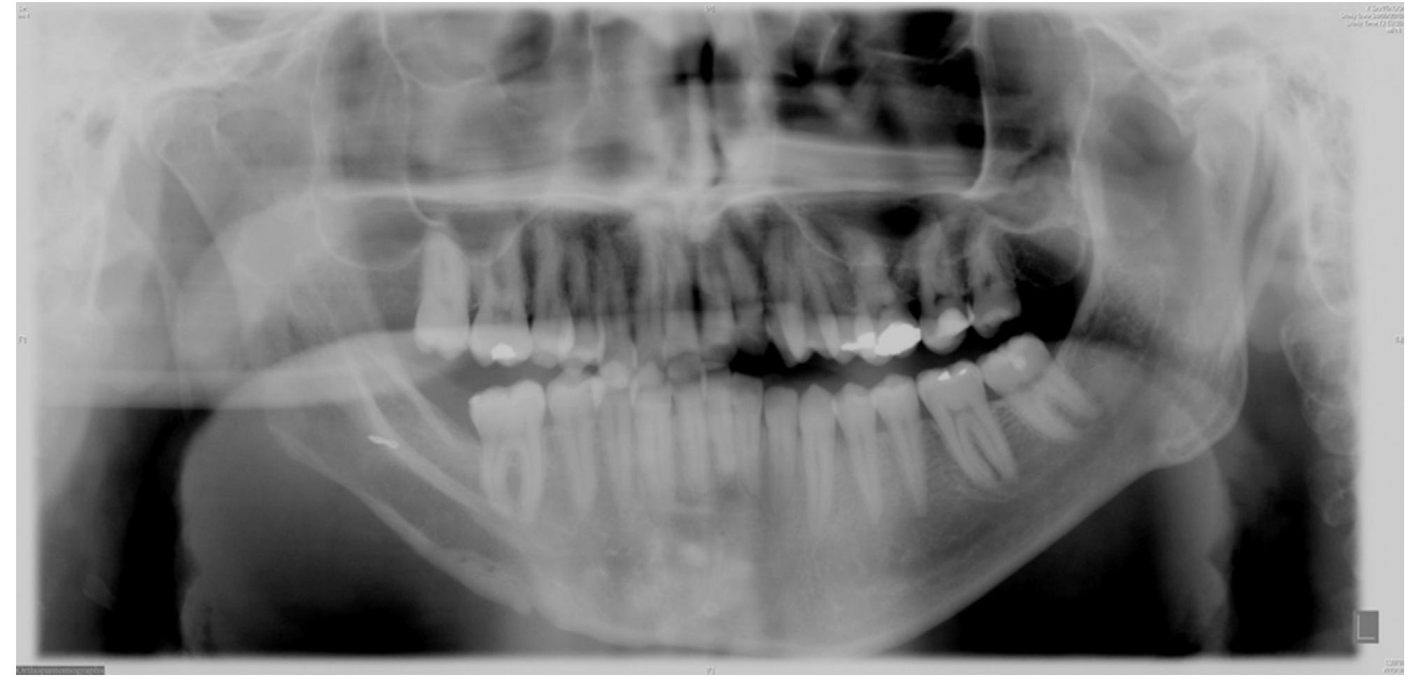 Distraction View (PDF) A New Method to Improve Defects of the Mandibular Angle Using an ...