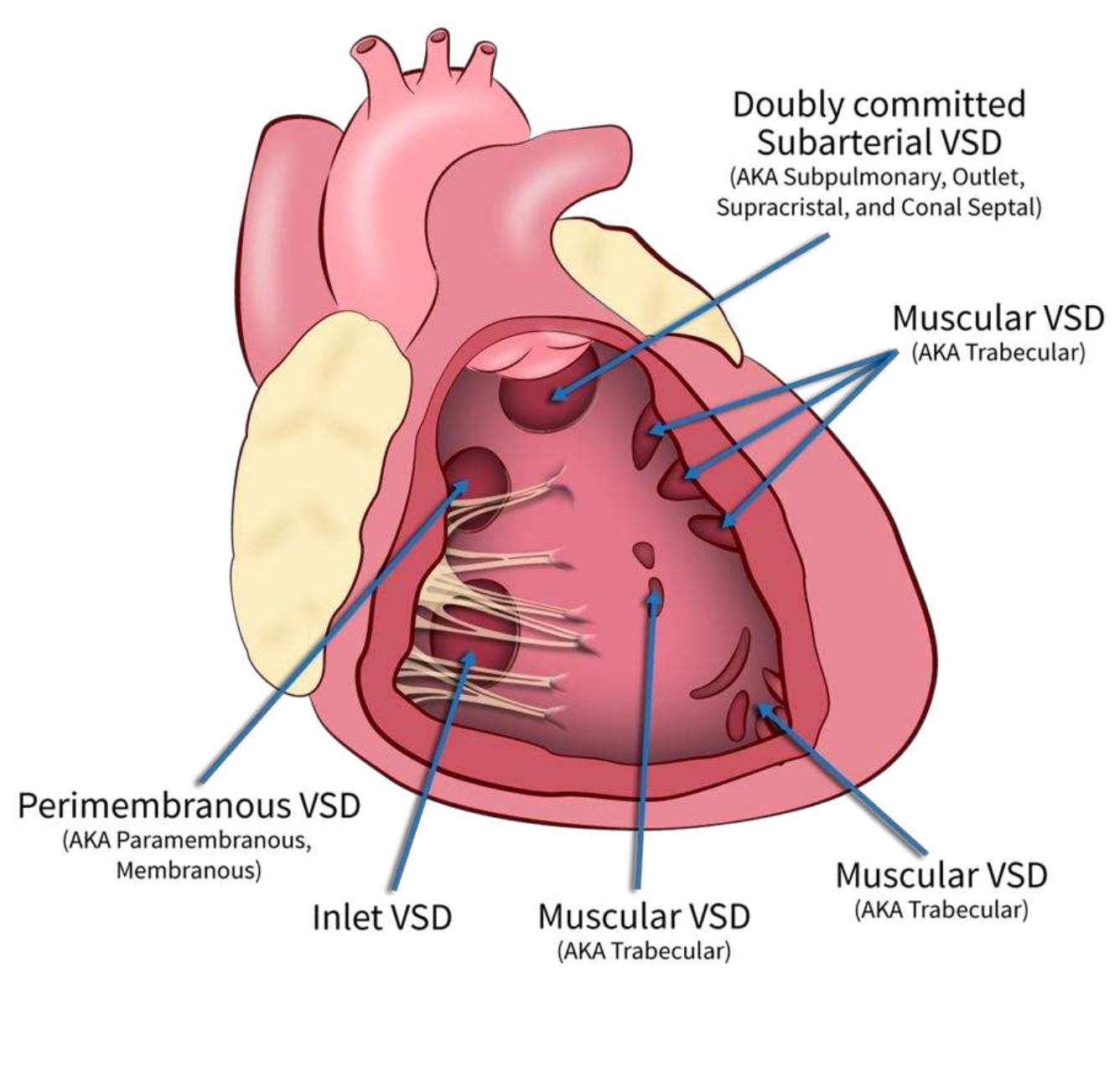 Vsd Management (PDF) Pathophysiology, Investigations, and Management of Ventricular ...