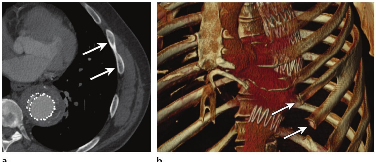 Bifid First Rib _bifid rib. (a) axial ct image shows two anterior bodies