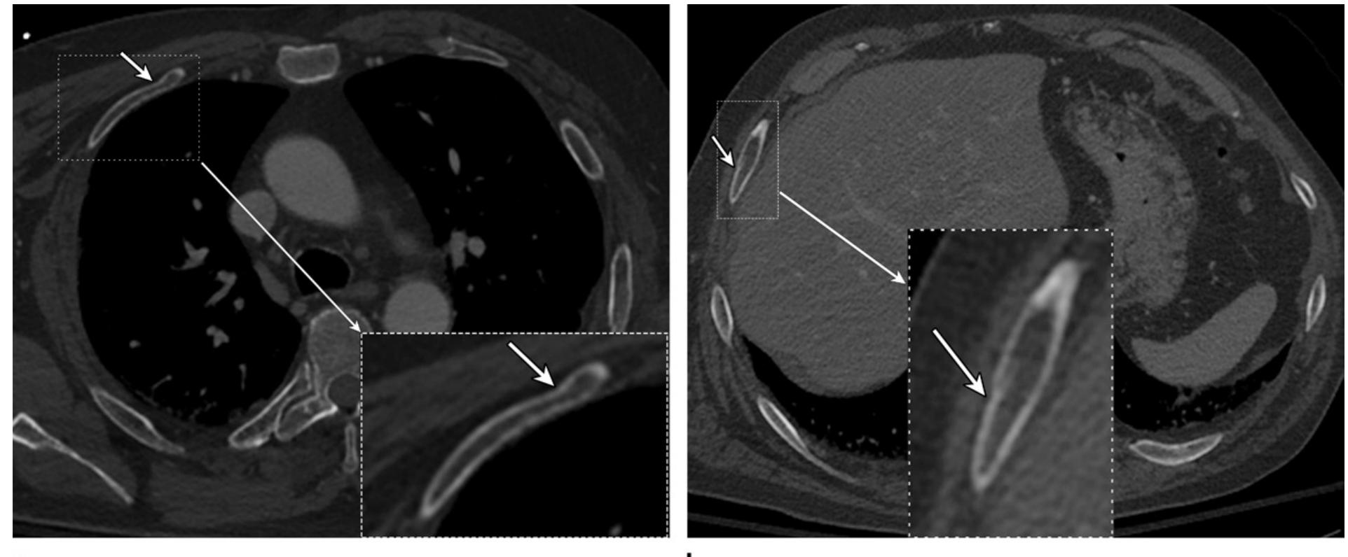 Buckled Rib (PDF) Traumatic Rib Injury: Patterns, Imaging Pitfalls, Complications ...