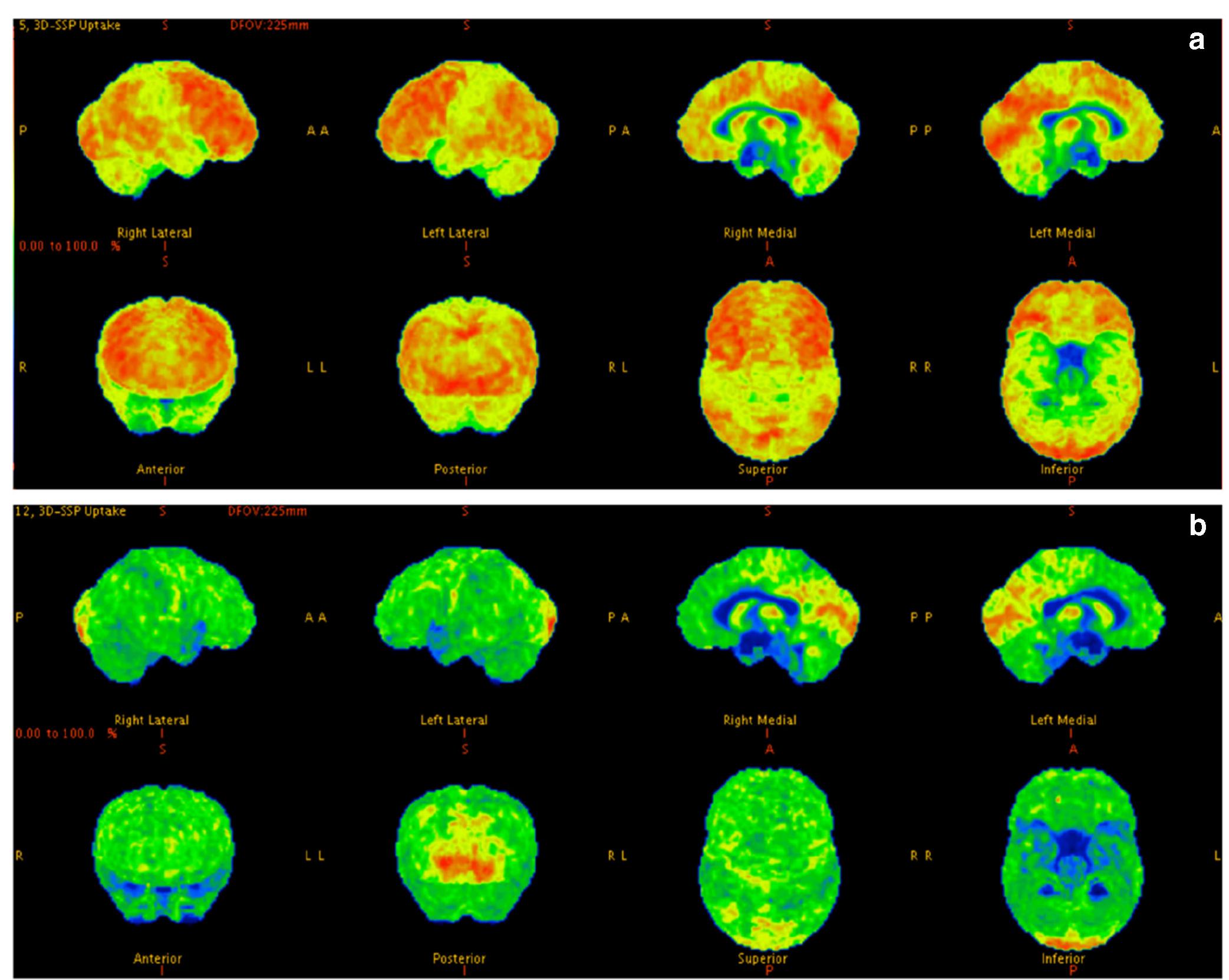 (PDF) Acute and Transient Psychotic Disorders: Newer Understanding